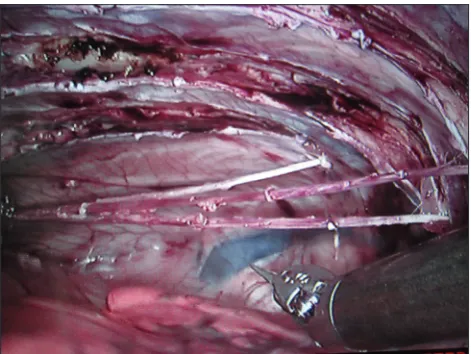 Figure 2: Intrathoracic view of three intercostal nerves in a pig harvested with the DaVinci® robot during a telemicrosurgical intervention