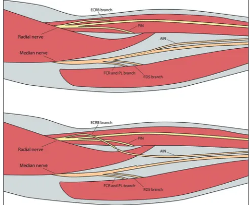 Figure 2: Distal median nerve deficit. Transfer of the terminal branch of the anterior interosseous nerve to the motor branch to the thenar muscles, using an interpositional graft