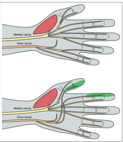 Figure 4: Sensory median nerve deficit. Transfer of the sensory branches from the ulnar nerve to the fourth web space to the sensory branches of the first web space