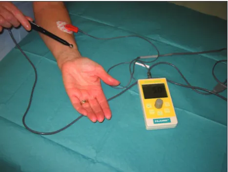 Figure 1: External neuromodulation requires minimal, inexpensive equipment which includes an external neuromodulator, electrocardiogram electrode and stimulating probe