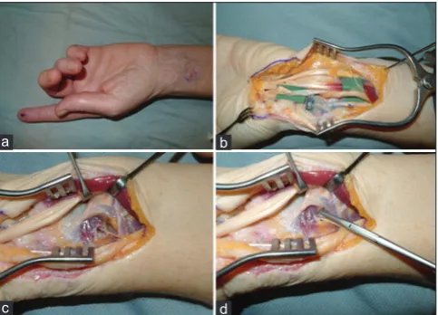 Figure 3: Technique of relocation of dorsal branch of ulnar nerve into ulna. (a) End neuroma of dorsal branch of ulnar nerve; (b) nerve dissected proximally; (c) nerve end can be placed in the ostium in distal ulna without tension; (d) epineurium is sutured to the periosteum to prevent displacement of nerve end