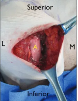 Figure 1: Bilateral areola‑sparing mastectomy defects