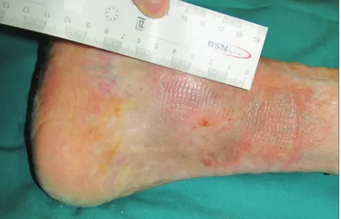 Figure 3: At t1 (9 days postoperative), 50% reduction of dimensions and improvement of wound bed