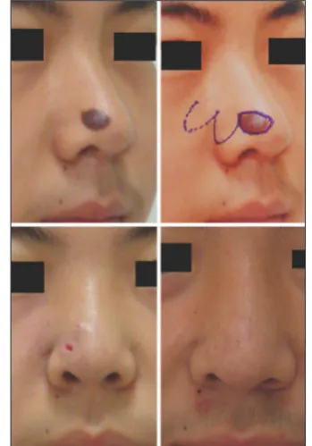 Figure 2: Modified bilobed flap reconstruction of nasal tip defect in a 20-year-old woman: the bilobed flap design (left); immediately after the operation (center); at the 1-year follow-up (right)