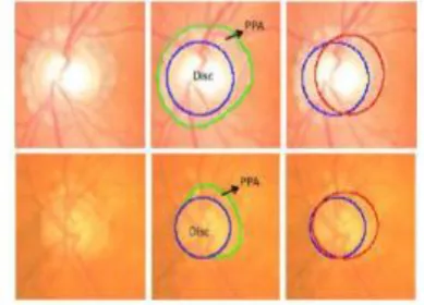 Fig 3 describes the Superpixel based optic disc segmentation. Each image is divided into superpixels