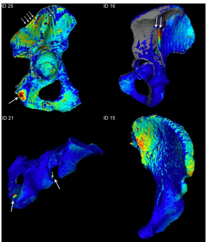 Figure 2:  visualized by our method. [0-6 mm]. Color mapped surface distances and standard deviation (ID 15), cold-to-hot mapped (e.g