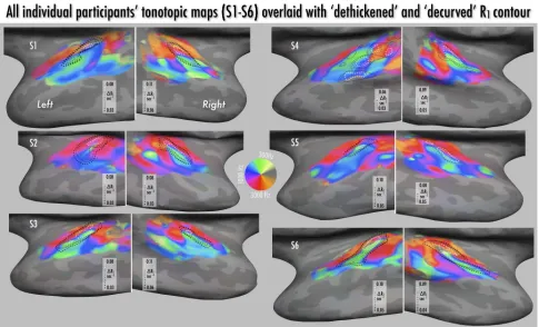 Figure 7.Functional tonotopic maps of an individual subject with focus on the right hemisphere of the inflated superior temporal lobe