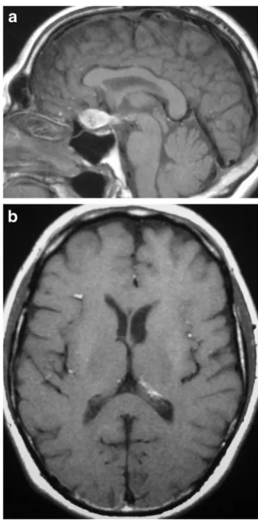 Fig. 16 Arachnoid cyst. Sagittal T1WI (well defined cystic mass with low T1 and high T2 signal intensity witha) and coronal T2WI (b) show asellar and suprasellar components