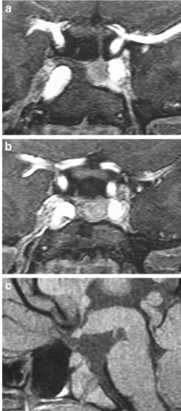 Fig. 7 Pituitary duplication. Coronal post-contrast images (a and b)show two pituitary stalks which extend inferiorly into separateduplicated pituitary glands