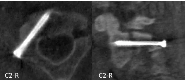 Figure 1: Postoperative computer tomography scans indicating the results of the C2 screw for safety analysis