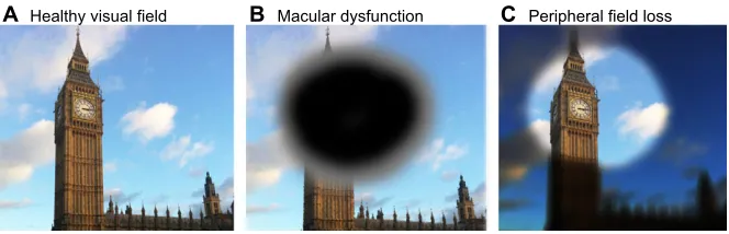 Fig. 2. The effects of retinal pigmentepithelium damage on visual field. (A