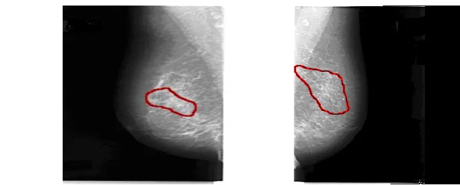 FIGURE 6: Detected micro calcifications after texture analysis using GLCM and K- means clustering method