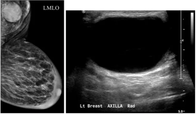 Fig. 12 A 80-year-old female with a history of sarcoidosis presentingwith a left axillary mass 1 year following axillary surgery of a benignnode