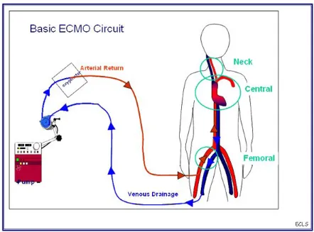 Figure 1. The essential ECMO circuit14