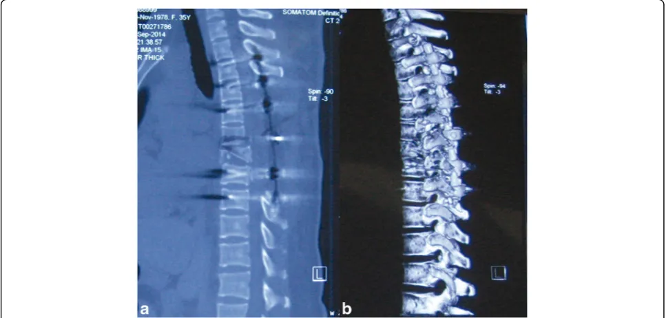 Fig. 4 Postoperative computed tomographic scans of the thoracic spine. a Axial view revealed the decompression of the spinal canal andreduction of T6&T7 dislocation