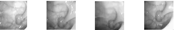 Figure 1. Frames of a video sequence showing a polypoid tumor of the colon. 