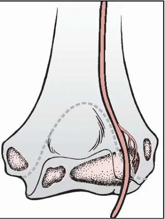 Figure 5. The most common mechanism of injury is believed to occur when the elbow is forced into varus (bottom left), which, applies an avulsion force to the lateral condyle