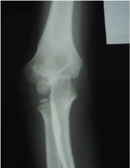 Figure 11. The overgrowth of lateral condyle fracture of boy 4 