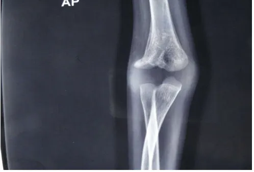 Figure 12. Nonunion of lateral condylar fracture After 18 month follow up (photographed by researcher)  