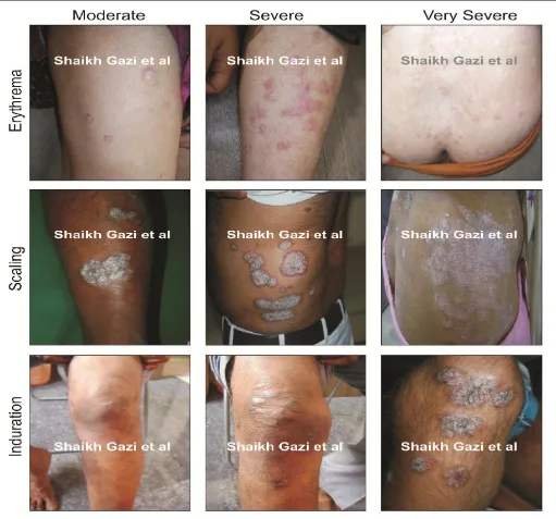FIG. 1: CLINICAL PHOTOGRAPHIC EXAMPLES OF PSORIASIS PATIENTS