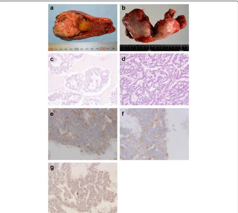 Fig. 2 Macro and microscopic findings of the gallbladder. Gallbladder tumor with stone (a) and hepatic hilar lymph nodes (b)