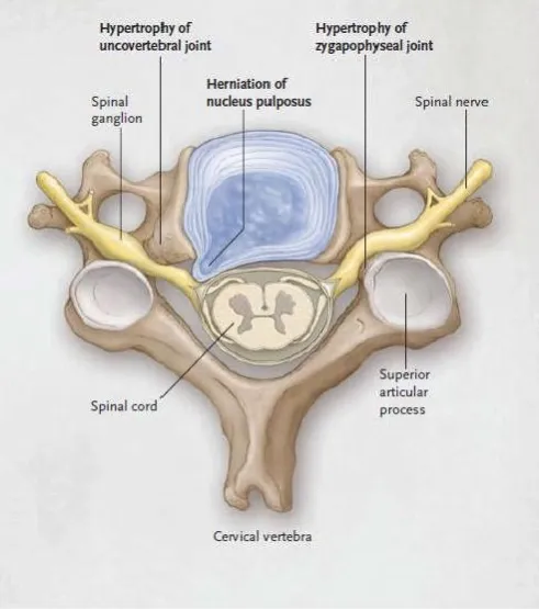 Figure 2. Showing cervical spondylosis 
