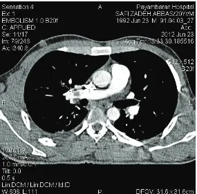 Figure 3.  Spiral CT,showing no pulmonary paranchymal lesions 