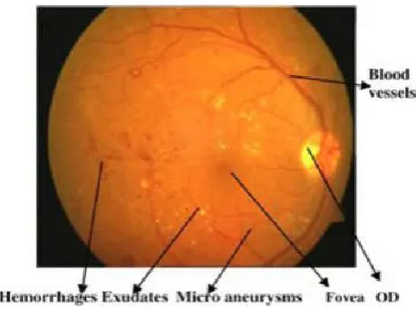 Fig 1. Retinal lesions associated with diabetic retinopathy 