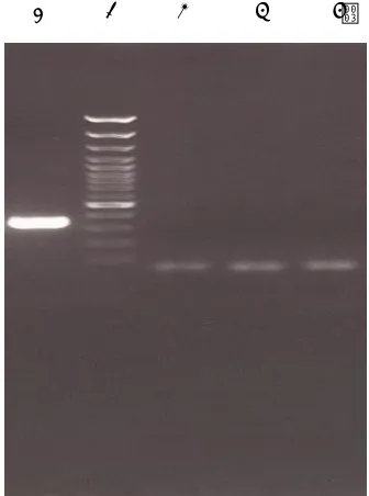 Fig 2. Gel electrophoresis for  evaluation c.196C>T polymorphism in MAPK8IP2 gene. Lane 1: molecular weight  marker (50bp); Lane 2: wisdom tooth follicle; Lane 3: Ameloblastoma; Lane 4: Ameloblastic Carcinoma; Lane 5: Undigested PCR product (210bp)