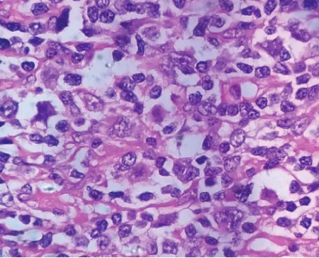Figure 1: Section from lymph node showing Hodgkin’s and Reed-Sternberg cells. (haematoxylin and eosin, magnification 100×)