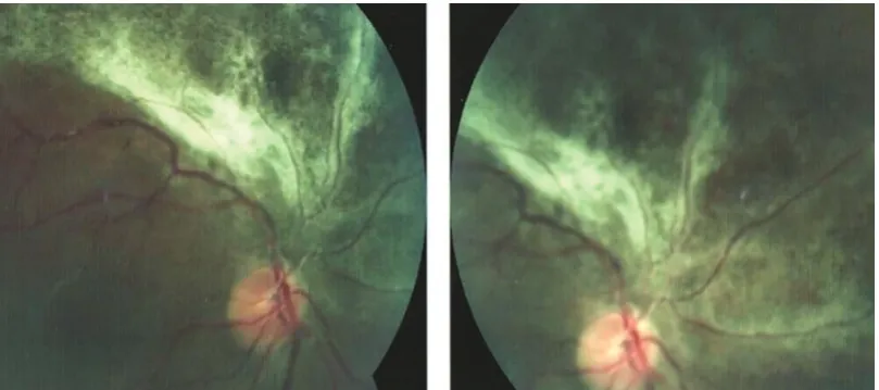 Figure 1: Retinitis in the midperiphery with a “brush fire” pattern