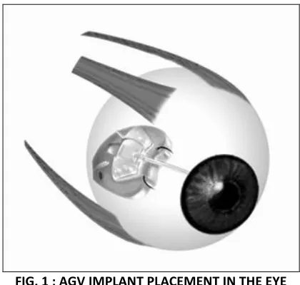 FIG. 1 : AGV IMPLANT PLACEMENT IN THE EYE 