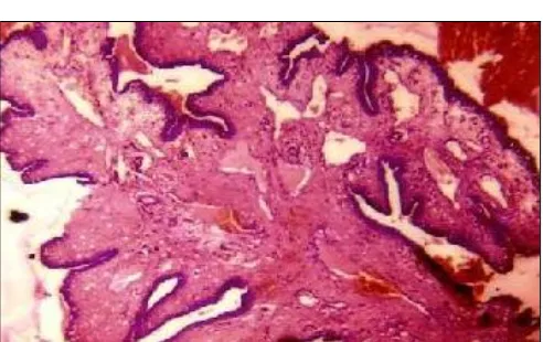 FIG. 2: SALPINGITIS ISTHMICA NODOSA- DIVERTICULAE OF  TUBAL EPITHELIUM, THE THICKENED WALL SEPARATED BY BROAD BANDS OF SMOOTH MUSCLES (H & E- 4OX) 