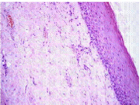 Fig. 4.2.  Microscopic image of OSMF showiowing an atrophic epithelium and fibrous connective tissue; E-EConnective Tissue; K-KeratinEpithelium; CT-in 