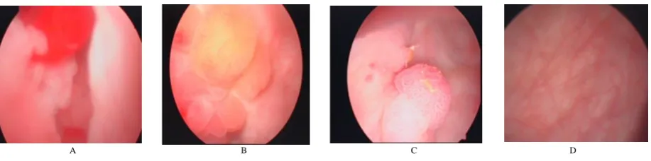 Figure 3: Examples of database images. A) An example of a malignant bladder tumor, B) An example of a benignbladder tumor, C) An example of blood bladder image, d) An example of normal bladder image