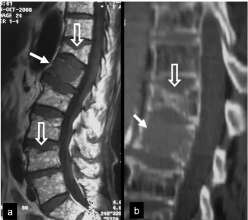 Figure 6operative results (case 3)The lateral and AP x rays of the lower spine show the post-The lateral and AP x rays of the lower spine show the postoperative results (case 3)