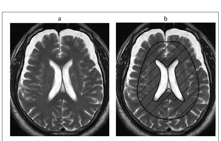 Figure 1: MR T2W images. (a) healthy brain image, (b) Periventricular and corpus Callosum approximate areas (dashed)