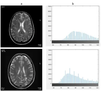 Figure 5: histogram differences of two MRIs, a healthy person (top row), and an MS patient image (bottom row)