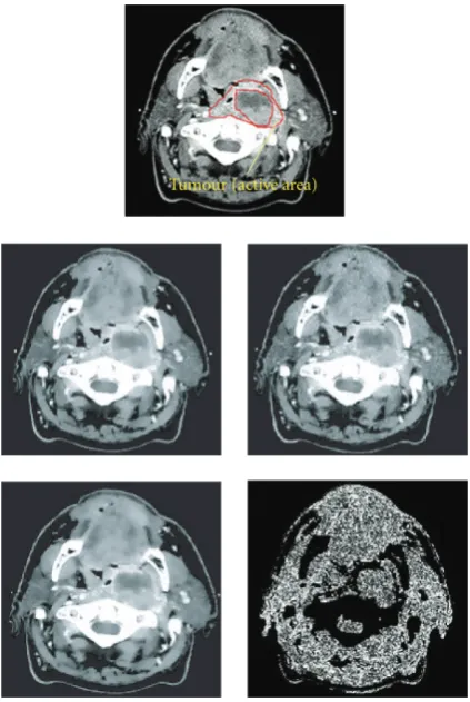 Figure 9: Top: the annotated original image, middle row: PM ﬁl-tering (smooth muscles) and PM ﬁltering (good quality tumour),bottom row: proposed ﬁltering and diﬀerence with the original.