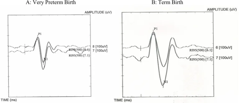 Fig. 1. P1 and N1 Waves of the cVEMP test from a Very Preterm Child (A) and a Term Child (B)