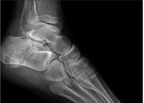 Figure 1: A 30‑year‑old male with bilateral calcaneal fractures after a fall from height