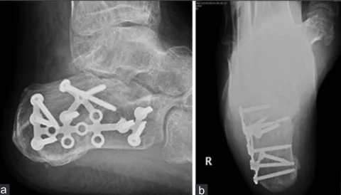 Figure 4: Same case. Follow‑up radiographs anterior‑posterior (a) and lateral (b) at 12 months