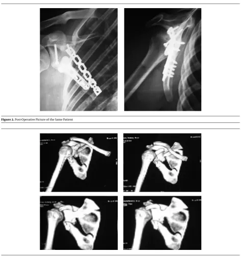 Figure 2. Post- Operative Picture of the Same Patient