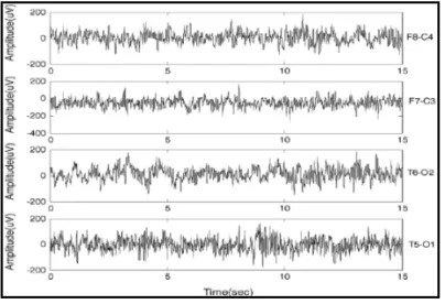 Figure 3:   Normal EEG Signal Sample  