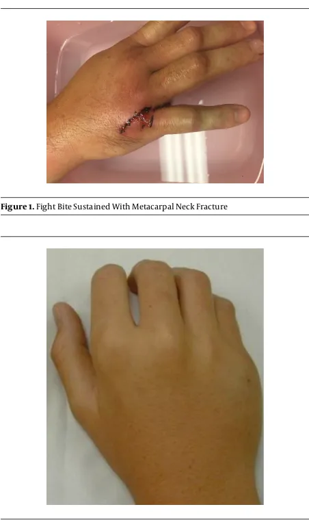 Figure 1. Fight Bite Sustained With Metacarpal Neck Fracture