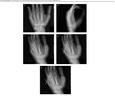 Figure 4. Radiographic A ssessment of Metacarpal Neck Fractures, Note the Dorsal A ngulation