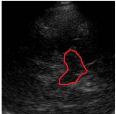 Fig. 1. TCS of a patient with normal raphe nu-clei echogenicity (outline of the midbrain is de-lineated with red  and the raphe echogenicitywith yellow color)