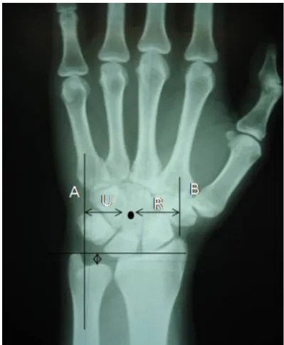 Fig. 1. Line A, axis of the third metacarpal, used to measure length .Line B, continuation of the third metacarpal axis used to measure carpal height