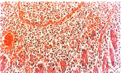 Fig. 8. Small intestine-large cell lymphoma