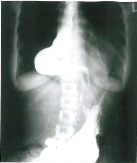 Fig. 2. CXR CPA) demonstrates a large middle mediastinal mass in the region of the esophagus